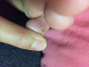 治疗鸡眼视频,跟随专家视频教程学护理